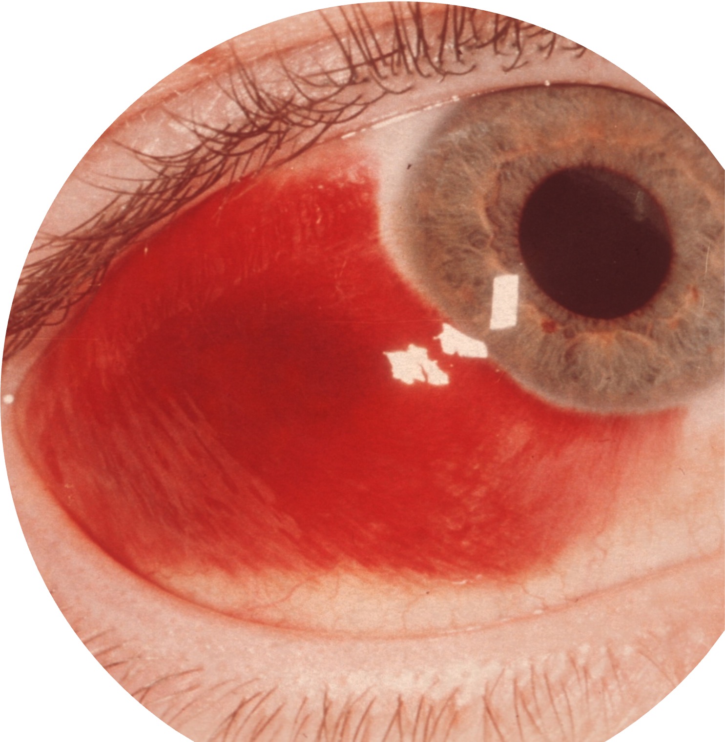 <p>True or false - subconjunctival haemorrhage is an ocular emergency.</p>