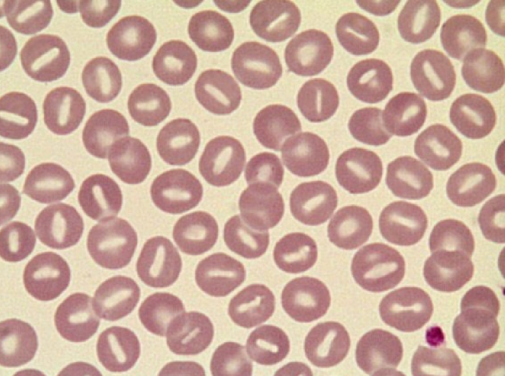 * Oval area of central pallor
* causes: Hereditary stomatocytosis, Hepatopathy, Iron deficiency