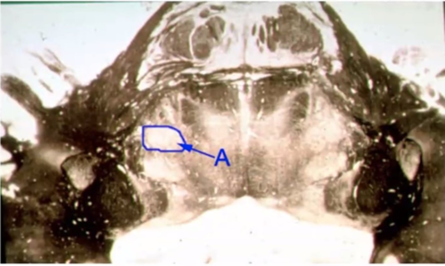 <p>A lesion to structure "A" will result in <br><br>A. Ipsilateral dysarthria & dysphagia <br><br>B. Ipsilateral loss of parasympathetic control <br><br>C. Ipsilateral loss of pain & temp to the face<br><br>D. Ipsilateral flaccid paralysis of the facial expression muscles (Bell Palsy)<br><br>E. Ipsilateral loss of tactile sensations to the face</p>