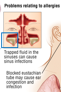 <p><strong>Maxillary. </strong> Trapped fluid in the sinuses, especially the maxillary sinus, can lead to <strong>secondary sinus infections.</strong></p>