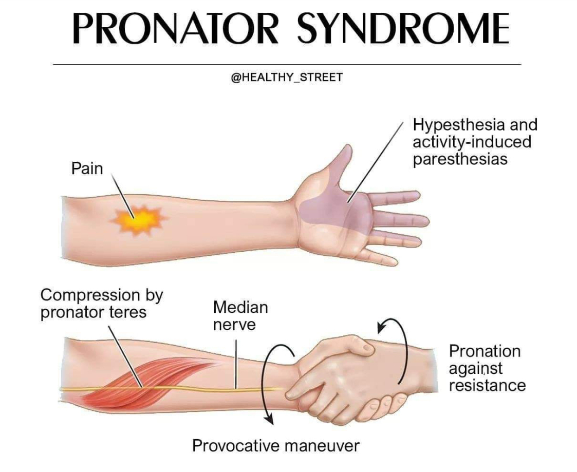 <p>-Median nerve compression between two heads of pronator teres<br>-from repetitive pron/supination <br>-positive tinel's sign at forearm<br><br>Conservative tx (elbow splint at 90 with forearm neutral)<br><br>Post op tx (AROM, nerve gliding, strengthening 2wk)</p>