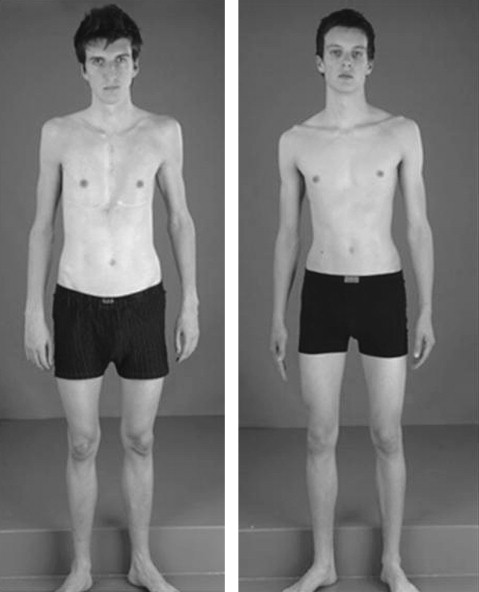 <p>Marfan’s syndrome</p>