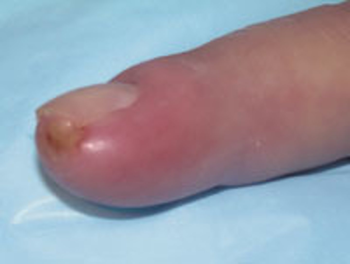 <p>diagnose this:</p><p>Think pad of finger; Pain, erythema, edema</p>