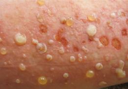 <p><span>Circumscribed elevations of the skin containing clear fluid, &gt;1 cm in diameter</span></p>