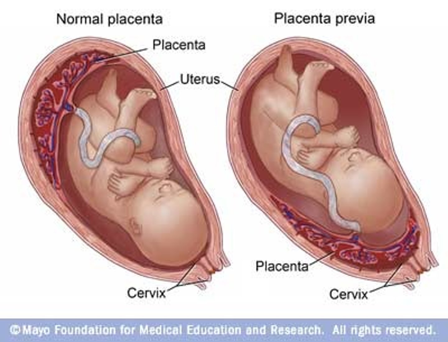 <p>Major symptom is PAINLESS bright red bleeding</p><p>placenta is covering the cervix </p>