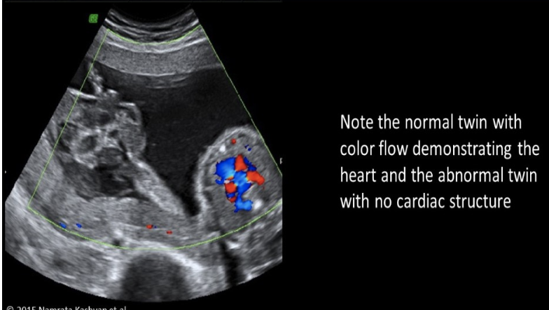 <p>pt has her 1st US at 22w. a twin pregnancy w/1 placenta. fetus A shows increased C/T ratio, mild pleural effusion, and anasarca. No cardiac activity can be identified in fetus B. there is no obvious cranial or cerebral structure</p><p>a) fetus A - hydrops, fetus b - triploidy</p><p>b) vanishing twin syndrome</p><p>c) twin reversed arterial perfusion sequence</p><p>d) dichorionic/diamniotic twins </p>