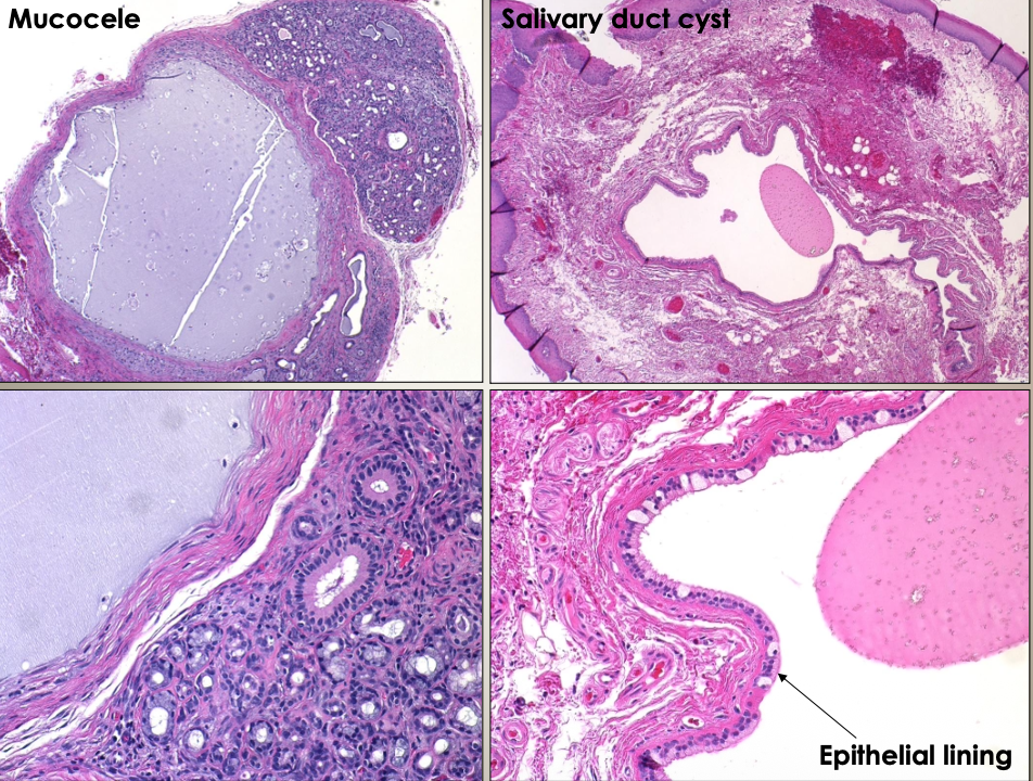<p>Microscopically. A salivary duct cyst has an epithelial lining</p>