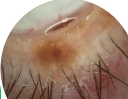 <ol><li><p><u>Flat </u>and even colored </p></li><li><p>Limited to<u> basal epidermi</u>s </p></li><li><p>Found in childhood</p></li></ol><p></p>