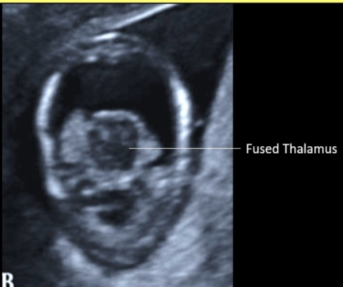 <p>a <strong>fused thalamus</strong> is identified in which cranial abn</p><p>a) semilobar holoprosencephaly only</p><p>b) alobar holoprosencephaly only</p><p>c) agenesis of corpus callosum + alobar holoprosencephaly</p><p>d) alobar + semilobar holoprosencephaly</p>