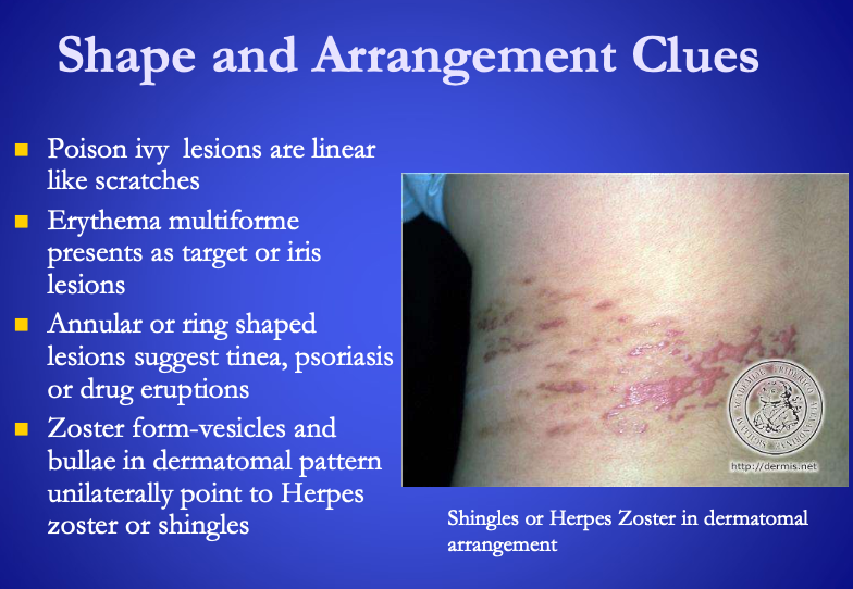 <p>Shape and arrangement clues</p><ul><li><p><span><strong>[...]</strong></span> lesions in:&nbsp;</p><ul><li><p>tinea</p></li><li><p>psoriasis</p></li><li><p>drug eruptions</p></li></ul></li><li><p>Zoster form vesicles and bullae in dermatomal pattern unilaterally point to <span>Herpes Zoster or shingles</span>&nbsp;</p></li></ul><p></p>