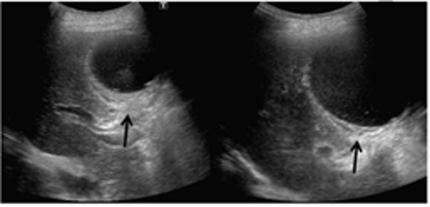 <p>gallbladder volvulus (GV), twists on itself</p><p>-rare, found in elderly females</p><p>-associated with mobile/floating GB</p><p>-surgical intervention as treatment</p>