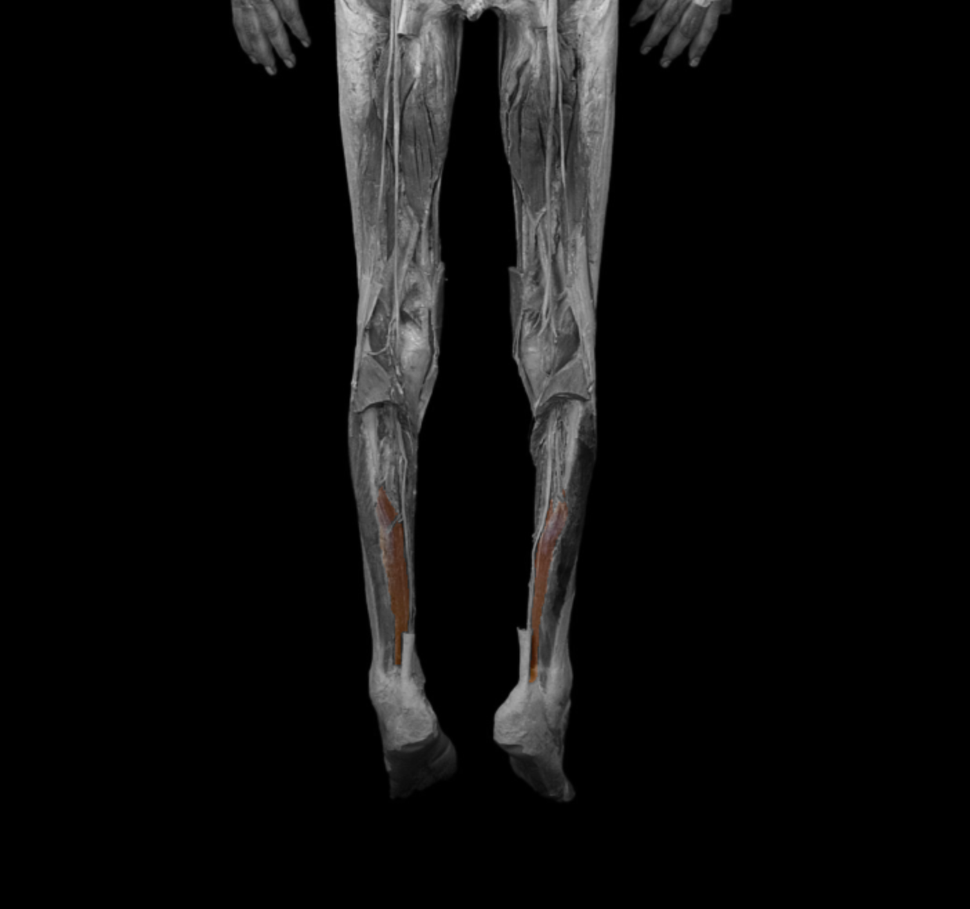<p>origin: posterior of fibula </p><p></p><p>insertion: distal phalanx of big toe </p><p></p><p>action: plantar flex, flex big toe </p><p></p><p>innervation: tibial nerve </p>