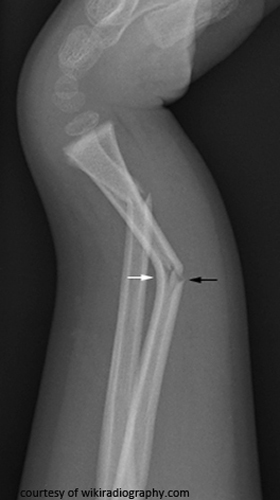 <p>What characterizes a greenstick fracture?</p>