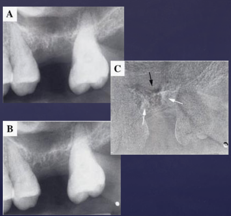 <p>• Image A-immediately after extraction</p><p>• Image B- one month later</p><p>• Image C- subtraction of figures A and B revealed areas of bone loss (black) and bone deposition (white)</p>