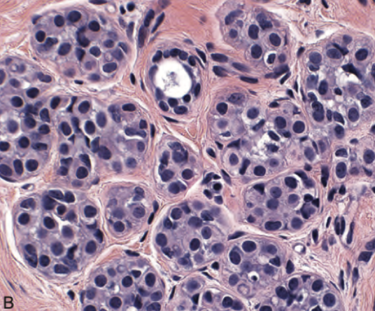 <p>HIperplasia lobulillar atipica </p>
