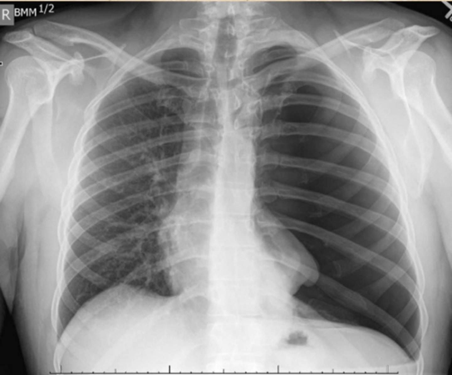 <p>What does this CXR show?</p>