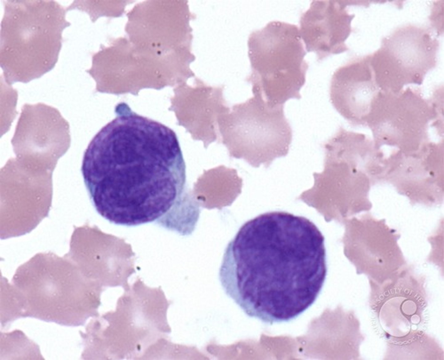 <ul><li><p>T-cell lymphoma with cutaneous mycosis fungoides</p></li></ul><ul><li><p>skin biopsies reveal an infiltration of lymphocytes.</p></li></ul><ul><li><p>spleen, bone marrow, and lymph nodes may become affected.</p></li></ul><ul><li><p>sezary cells are present in the PBS</p><ul><li><p>large, convoluted ovoid nucleus</p></li><li><p>may be mistaken for monocytes</p></li></ul></li></ul><p></p>