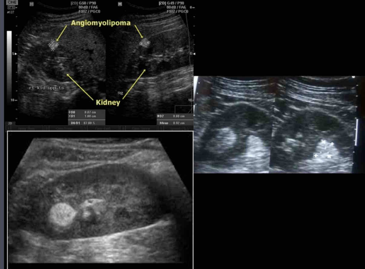 <p><span>What does this sonographic appearance describe?</span><br><span>1. Solid hyperechoic parenchymal mass.</span><br><span>2. Use color Doppler to assess the intramural flow.</span><br><span>3. Propagation speed artifact may result in posterior displacement of structures due to slow acoustic velocity in the fatty mass</span><br><span>4. 80% involve right kidney</span><br><span>5. Can undergo hemorrhage when large</span></p>