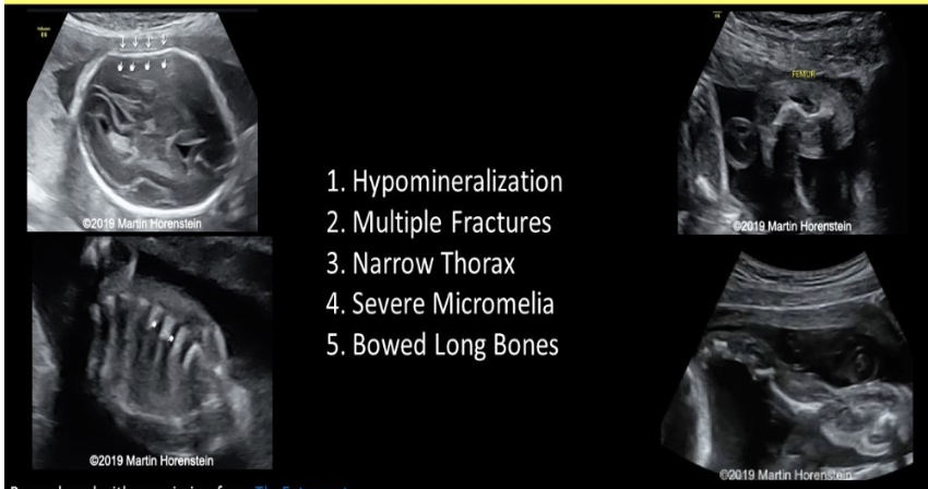 <p>a pt comes in for 20w measuring 12 days behind where they should be according to their 1st trimester scan. the cranial bones appear less echogenic. the humerus + femur appear slightly bowed. the small bones in the extremities are also somewhat difficult to identify due to decreased echogenicity</p><p>a) achondroplasia</p><p>b) thanatophoric dwarfism</p><p>c) IUGR</p><p>d) osteogensis imperfecta</p>