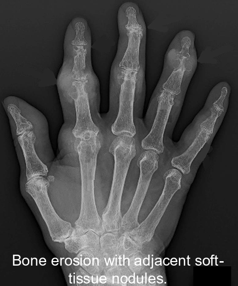 <p>Accumulation of sodium-urae crystals within joints<br><br><u>Pathogenesis</u>: Hyperuricaemia causing deposition of monosodium-urate crystals in the joints. Flare ups caused by immune response to urate crystals</p><p>Genes involved: SLC2A9 (for GLUT2 receptors), IL-37<br><br><u>Diagnosis</u>:</p><ul><li><p>Sudden onset of excruciating pain within the joint (often metatarsophalangeal)</p><ul><li><p>Advanced gout: recurrent flare with persistent joint pain</p></li></ul></li><li><p>Gold standard: presence of MSU crustals in synovial fluid taken from joint aspiration during flare</p></li><li><p>Serum urate >0.42mmol/L</p></li><li><p>Imaging via x-ray, ultrasound, CT shows urate crystals</p></li></ul><p></p><p><u>Treatment:</u></p><ul><li><p>Colchicine or NSAID’s (reduces inflammation)</p></li><li><p>Low dose allopurinol (lowers urate levels)</p></li><li><p>Ice (pain relief)</p></li><li><p>Lifestyle: limit alcohol, purines, sugar intake, weight loss in obese</p></li></ul><p></p>