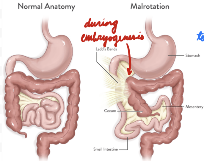 <p>Abnormal midgut rotation during embryogenesis = Improper fixing</p>