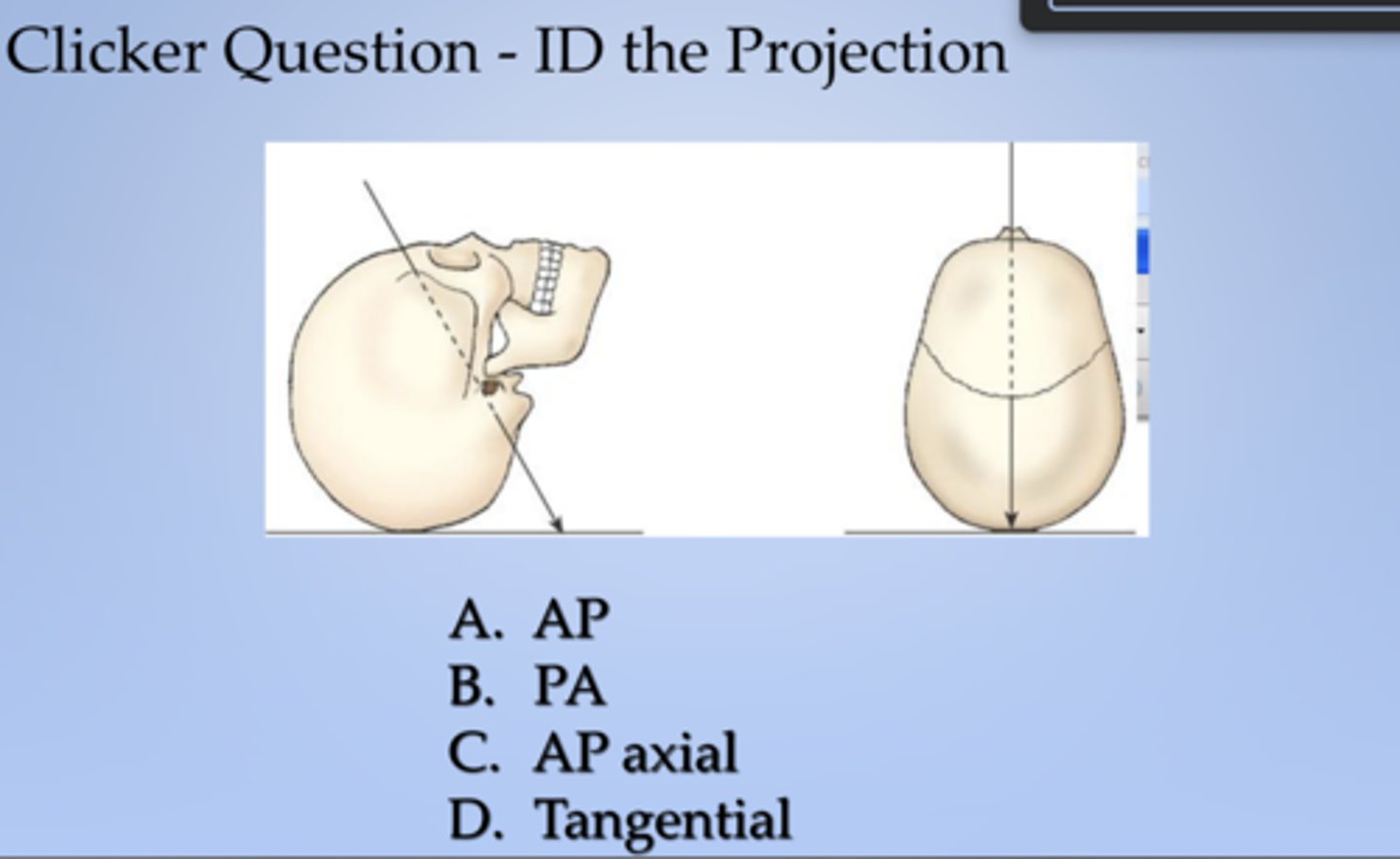 <p>ID the projection:</p><p>X projection of skull. Central ray enters anterior aspect at an angle and exits posterior aspect.</p>