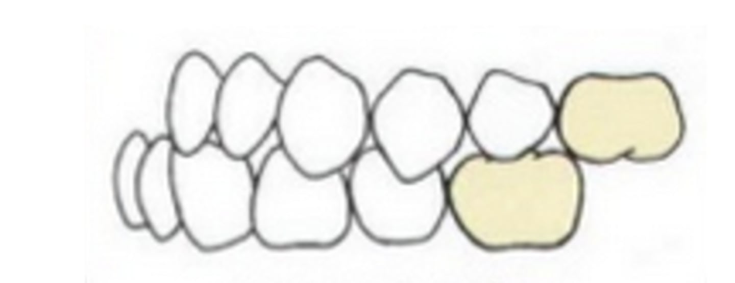 <p>ID the class of occlusion:</p>