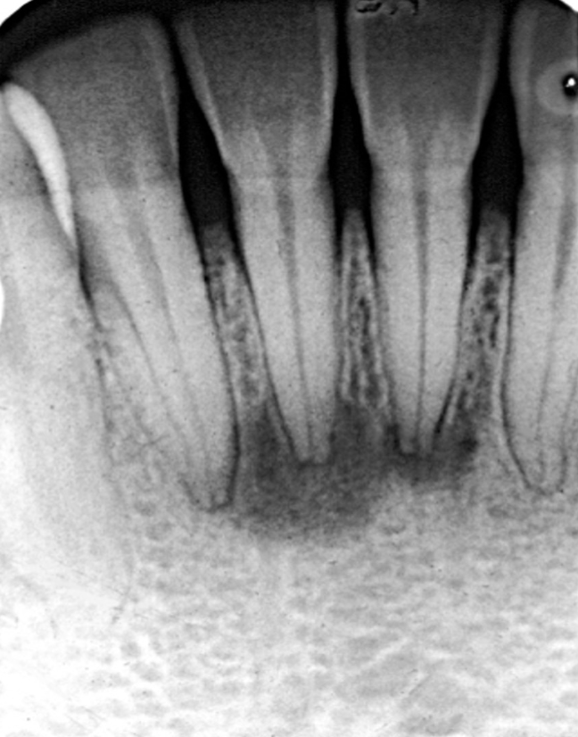 <p>benign, fibro-osseous lesion, with teeth remaining vital</p><ul><li><p>relatively harmless change in bone</p></li><li><p>can appear radiolucent, radiopaque, or become more radiopaque and less radiolucent as patient ages</p></li><li><p>often confused with apical periodontitis</p></li></ul><p></p>