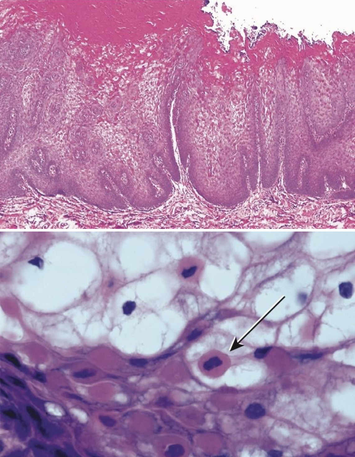 <p>which hereditary lesion histopathological features:</p><ul><li><p>Prominent hyperparakeratosis and marked acanthosis with clearing of the cytoplasm of the cells in the spinous layer</p></li><li><p>Perinuclear condensation of keratin tonofilaments (K4 and K13 mutation → clumping and spongy)</p></li></ul><p></p>