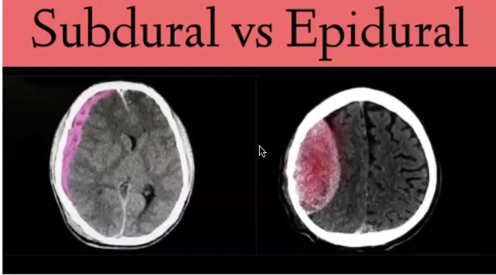 <p>blood has leaked out and collected somewhere</p><p><br>subdural: below the dura (crescent)</p><p>epidural: above the dura (lens)</p>