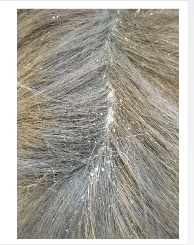 <p>Desquamated corneocytes on skin + hair </p>