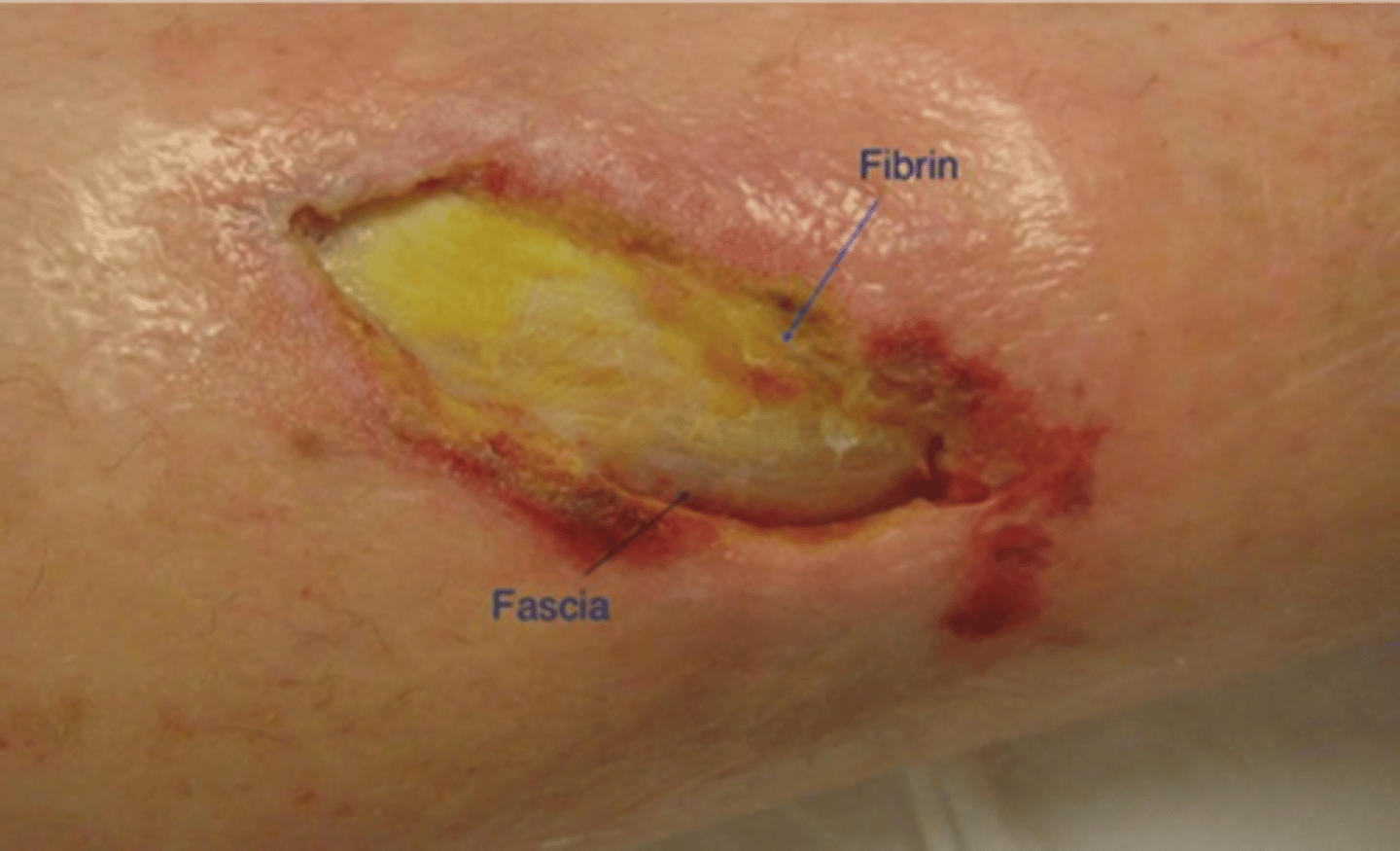 <p>Sheath covering muscle, nerves and blood vessels keeping them in tight bundles as a single unit</p>
