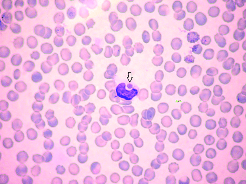 A 5-year-old M medium-sized mixed-breed dog presents to your clinic in early June for nasal discharge. The owner removed a Brown Dog Tick (Rhipicephalus sanguineus) from him and is upset he hadn’t yet restarted flea/tick prevention.

The patient has a fever, generalized lymphadenopathy, and splenomegaly. Bloodwork shows thrombocytopenia and the following is seen on peripheral blood smear. 

What condition are you concerned for?