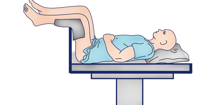 <p>lithotomy</p>