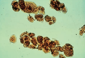 An RTE cast with bilirubin-stained cells