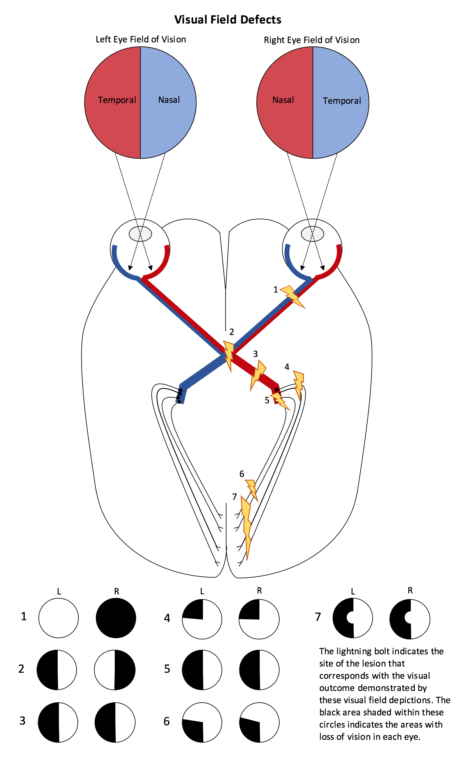 <p>homonymous hemianopsia</p><ul><li><p><span>same half of the visual field is lost in both eyes</span></p></li></ul><p></p>