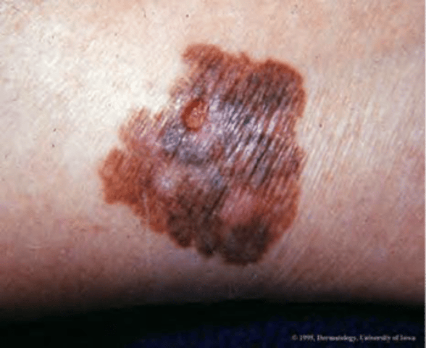 <p>ID skin cancer</p>