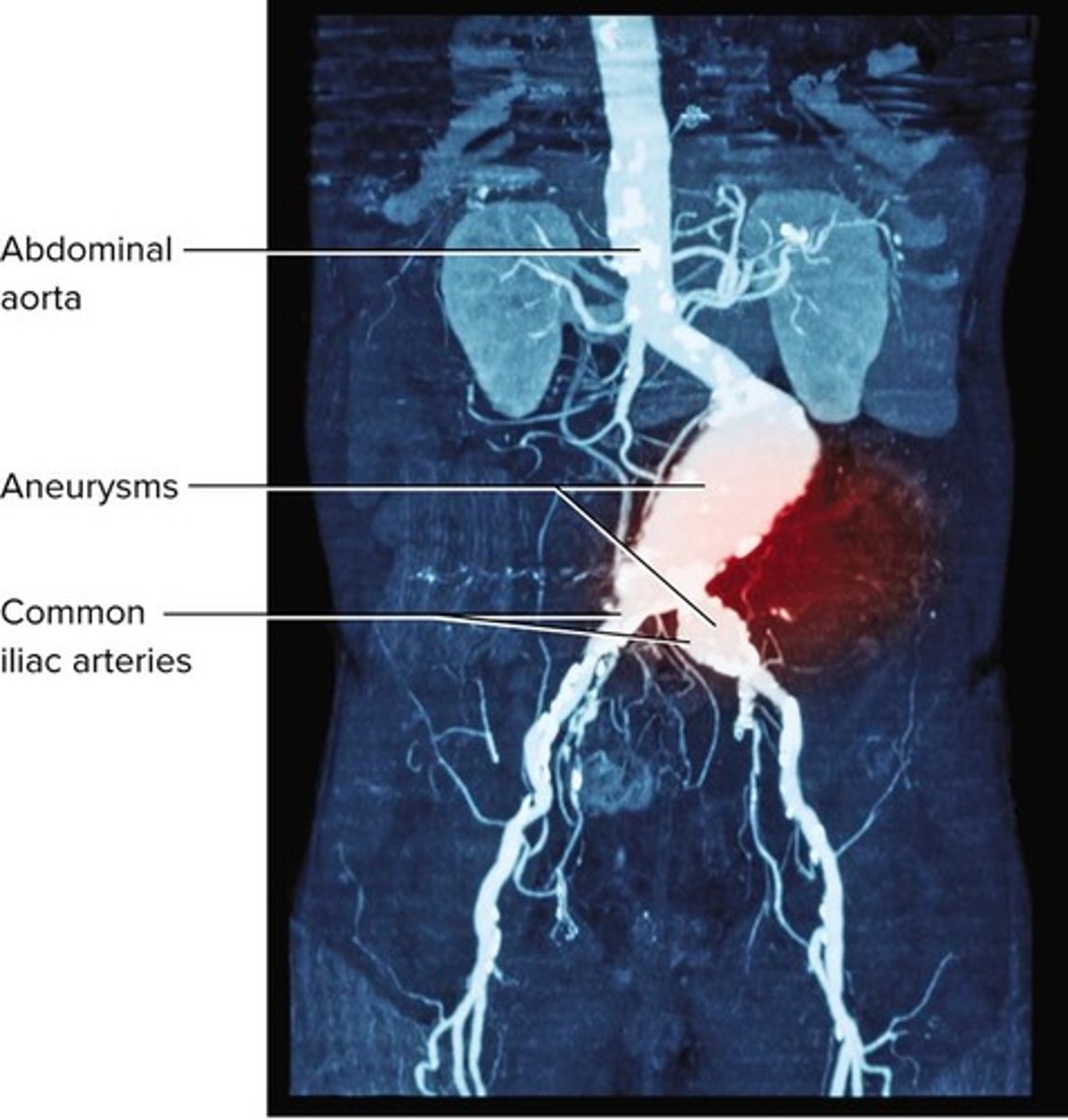 <p>A weak point in an artery or heart wall that forms a bulging sac that may rupture.</p>