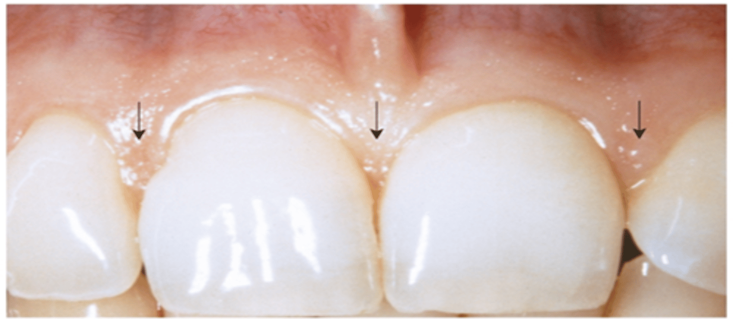 <p>prevents food from becoming packed between the teeth during mastication</p>
