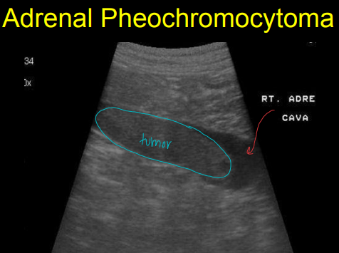 <ul><li><p><strong>Pituitary Dependent Hyperadrenalcorticism</strong></p><ul><li><p><strong>Bilateral</strong>, Common to <strong>look normal </strong>to <strong>enlarged</strong></p></li><li><p><strong>No invasion</strong></p></li><li><p><strong>Cushing’s</strong> in dogs</p></li></ul></li><li><p><strong>Adrenal Dependent Hyperadrenalcorticism</strong></p><ul><li><p><strong>Unilateraly big, </strong>other is atrophied</p></li><li><p><strong>Mass effect,</strong> no invasion</p></li><li><p>Uncommon in dogs</p></li></ul></li><li><p><strong>Adrenal Neoplasia</strong></p><ul><li><p><strong>Adenocarcinoma</strong></p><ul><li><p>large, irregular, <strong>invasive</strong> mass, <strong>bilateral</strong></p></li><li><p>Dystrophic <strong>mineralization</strong></p></li><li><p><strong>poor prognosis</strong></p></li></ul></li><li><p><strong>Pheochromocytoma</strong></p><ul><li><p>large, irregular, <strong>invasive</strong> mass, <strong>unilateral</strong></p></li><li><p><strong>good prognosis</strong></p></li></ul></li></ul></li><li><p><strong>Lymphadenopathy</strong></p></li></ul><p></p>