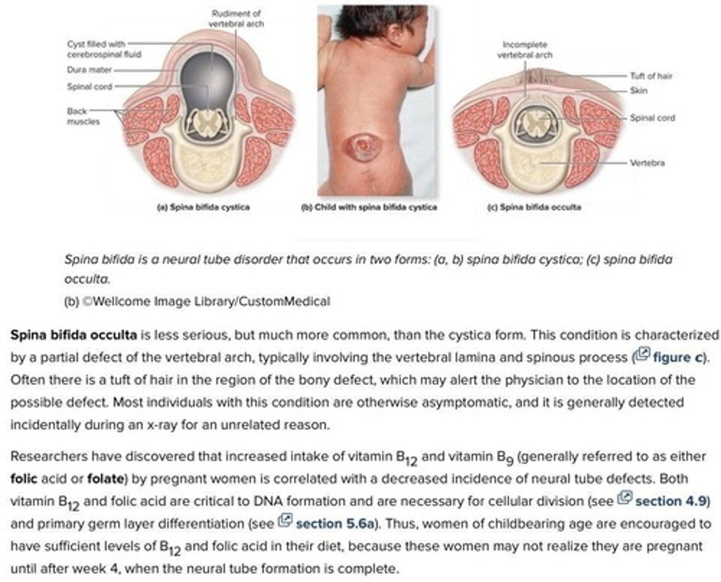 <p>A defect where the caudal portion of the neural tube fails to close, leading to varying degrees of spinal cord damage.</p>