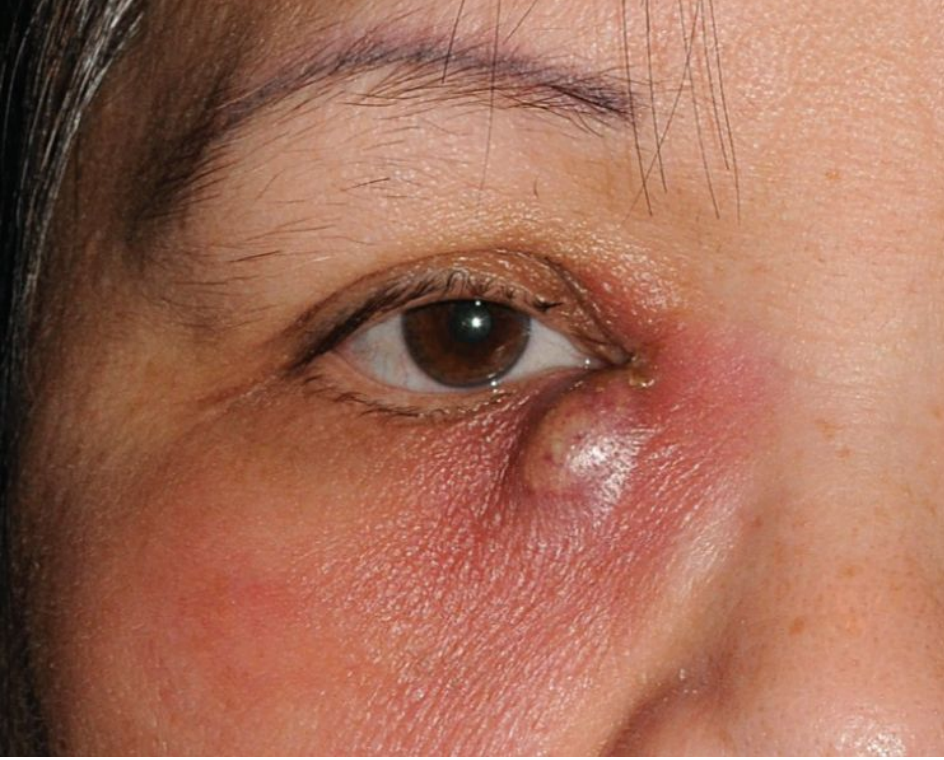 <p>What is the clinical term for inflammation of the lacrimal sac?</p>