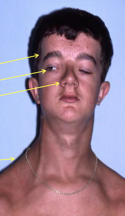 <ul><li><p>Big head</p></li><li><p>Pronounced frontal bossing</p></li><li><p>Ocular hypertelorism</p></li><li><p>Broad base of nose</p></li><li><p>Hypoplastic mid face</p></li><li><p>Long neck</p></li><li><p>Missing or hypoplastic clavicles</p></li><li><p>Short stature; Scoliosis</p></li><li><p>Delayed suture closure</p></li><li><p>Wormian bone</p></li></ul><p></p>