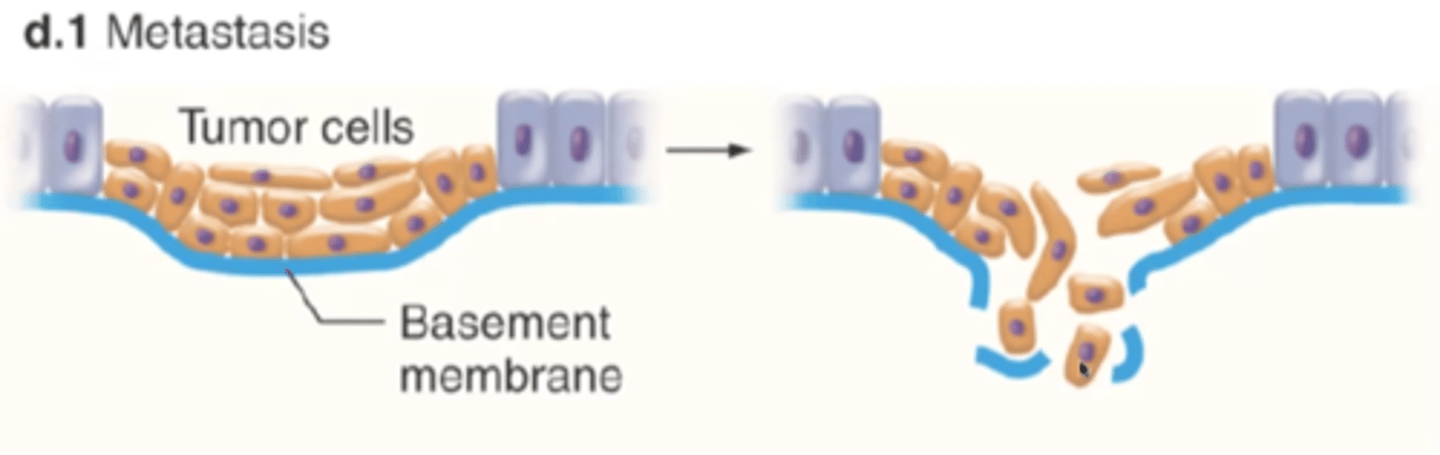 <p>spread of cancer cells beyond their original site in the body</p>