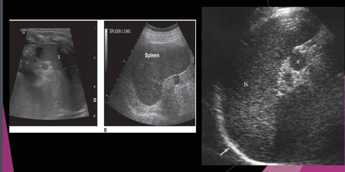 <p>True/False: Approximately 75% of accessory spleens are found near to the normal spleen within the splenic hilum or gastrosplenicligament omentum, rare locations for an accessory spleen include the pelvis or scrotum.</p>