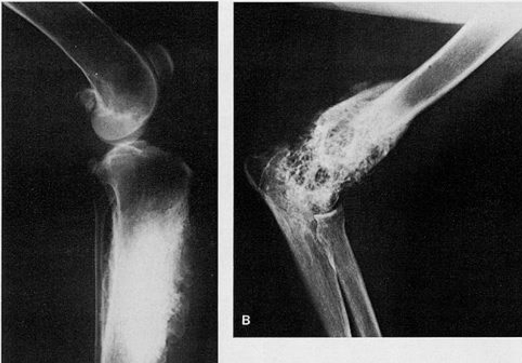 <p>describe osteomyelitis</p>