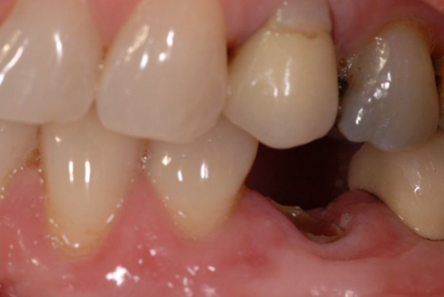<p>How would you define the structural damage to this tooth?</p>