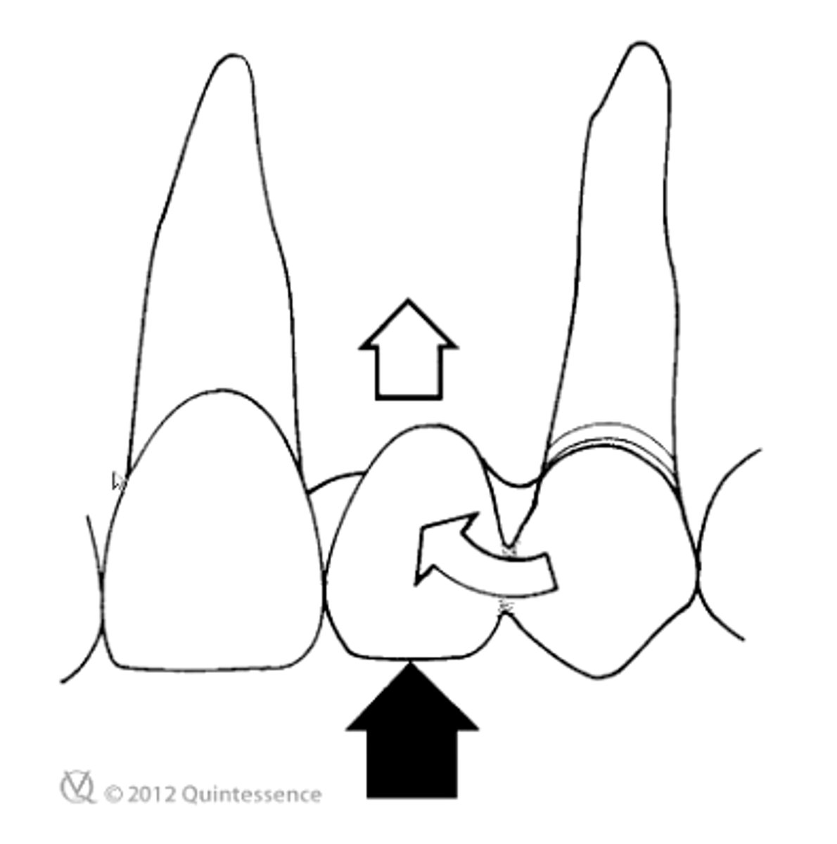 <p>T/F: Forces on the pontic of a cantilever fixed partial denture tend to tip the fixed partial denture or the abutment tooth</p>