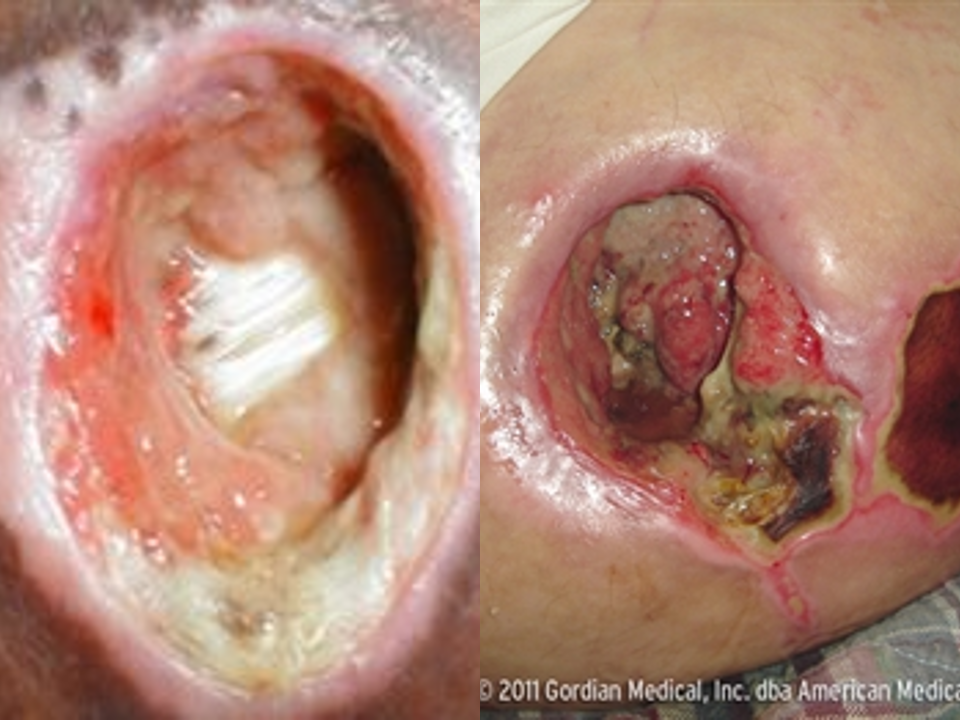 <p><strong>What stage pressure injury?</strong></p><ul><li><p>Full thickness skin loss with extensive destruction exposing muscle, tendon, cartilage or bone </p></li><li><p>tissue necrosis; slough &amp; eschar may be visible; epibole, undermining &amp; tunneling often occur</p></li><li><p>heal: scar formation and contraction</p></li></ul><p></p>