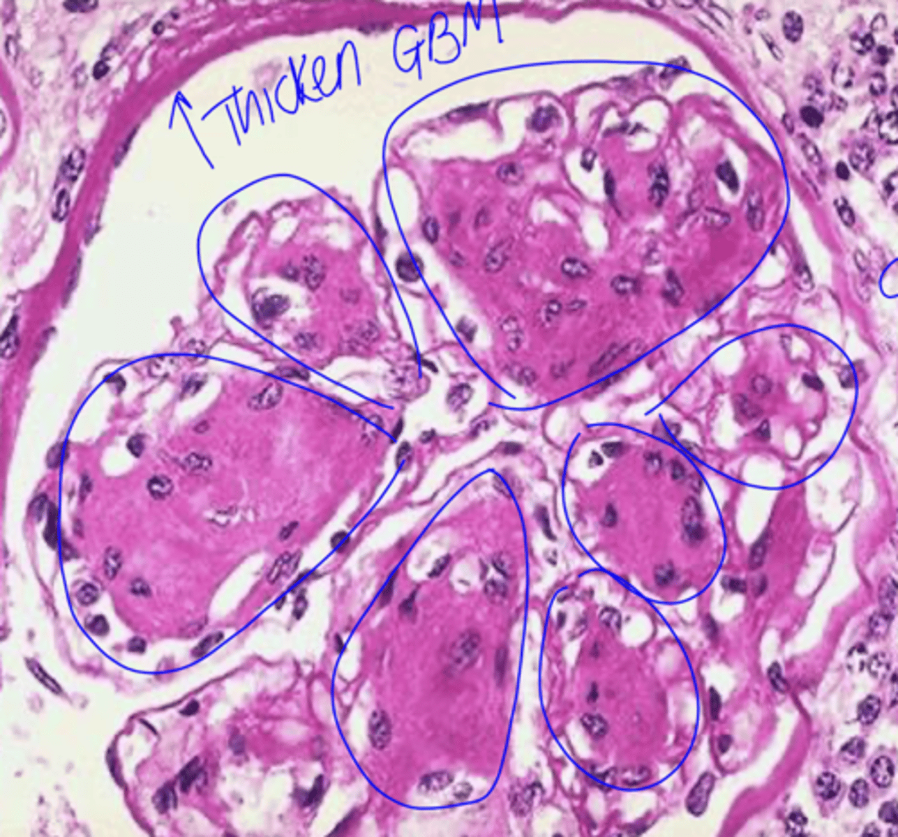 <p>diffuse mesangial sclerosis</p><p>nodular glomerulosclerosis</p><p>BM thickening</p>